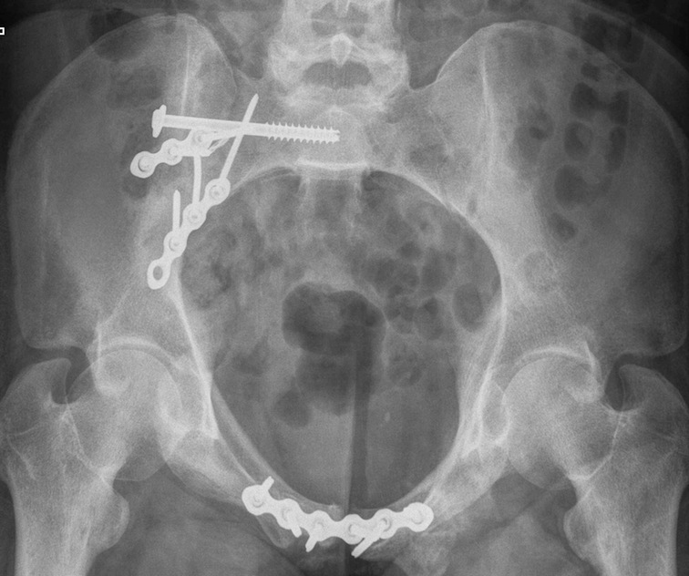 Pelvis Anterior Sacroiliac Plate 3